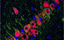 Moduler le cholestérol cérébral : une nouvelle piste de recherche pour traiter la maladie d’Alzheimer ?