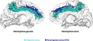 Illustration de la variabilité des formes du cortex cingulaire antérieur selon les enfants