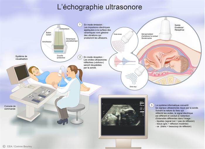 L’échographie ultrasonore