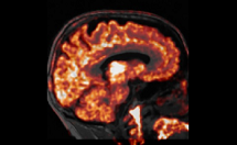 Evolution de la maladie d’Alzheimer : un rôle dual de la réaction neuroimmune