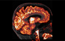 Evolution of Alzheimer's disease : a dual role of the neuroimmune reaction