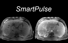 AI for rapid acquisition of MRI clinical images of large organs.