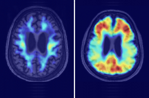 Amyloid and tau imaging for diagnosis of progressive amnesia