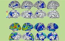Alzheimer : l'imagerie TEP-Tau permet de prédire le déclin cognitif et la progression de l'atrophie cérébrale