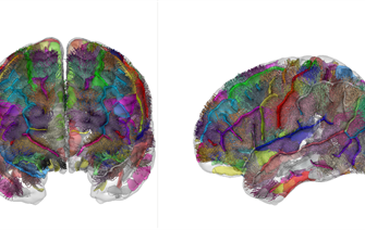 Une étude d’imagerie cérébrale semble remettre en cause le modèle théorique dominant sur l'autisme